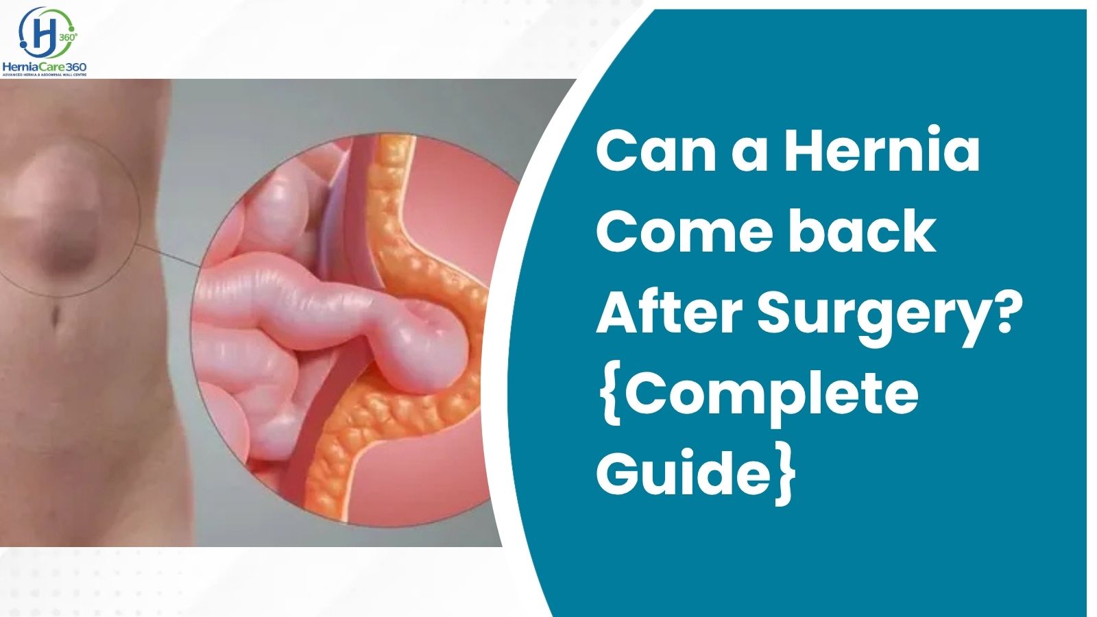 Can a Hernia Come Back After Surgery? {Complete Guide}